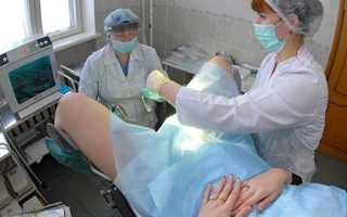 Каковы признаки абсцесса яичника у женщины