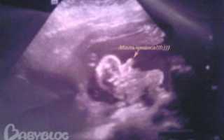 Тонус передней стенки матки