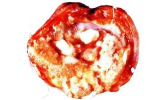 Опасные проявления незрелой тератомы правого и левого яичника