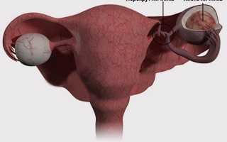 Причинные факторы появления перекрута яичника и способы его лечения