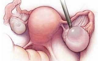 Для чего проводится резекция яичника