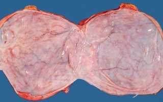 Появление цистаденомы яичника в менопаузе