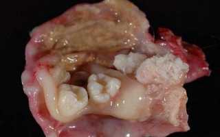 Диагностика и методы лечения тератомы яичника