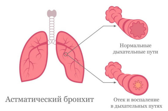 Причины астматического бронхита