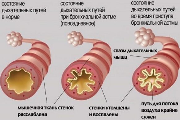 Diagnosis of bronchial asthma