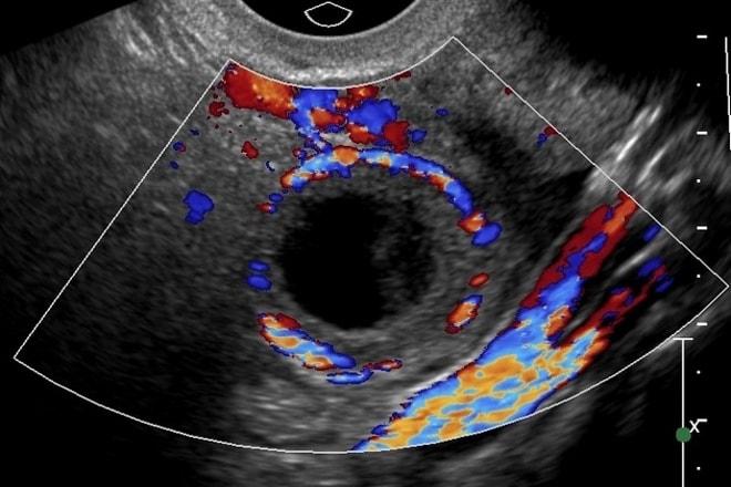 Анэхогенное включение на яичнике