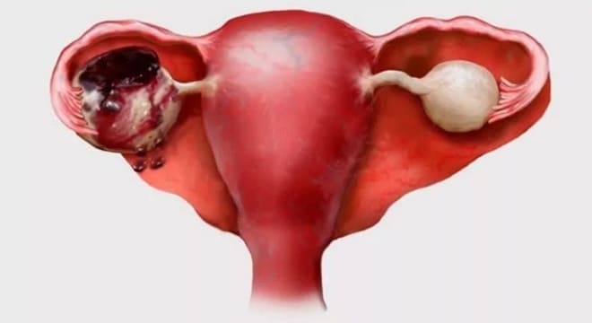 Разрыв кновообразования на придатке