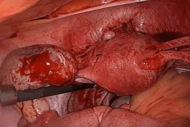 Разрыв (апоплексия)