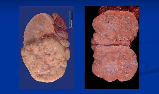 Дисгергинома яичника