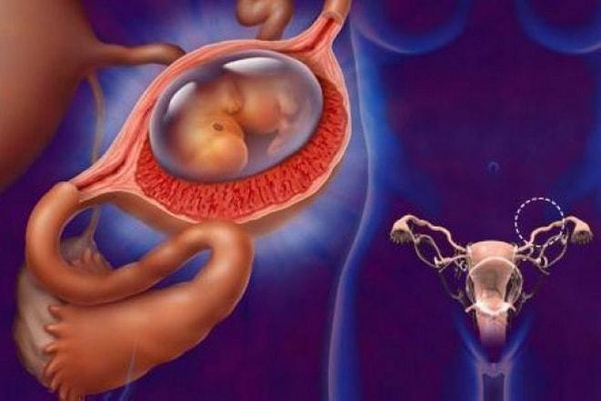 Боли в яичниках при внематочной беременности