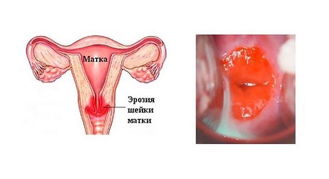 Эрозия шейки матки у женщины Эрозия шейки матки на фото