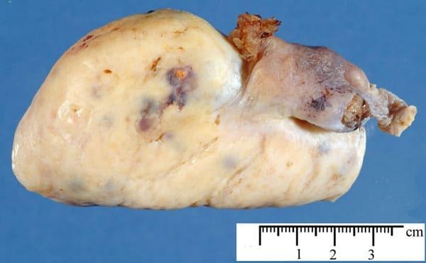 Как выглядит фиброма яичника на фото