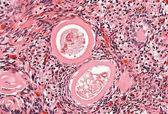 Отличительные особенности текомы яичника на фоо