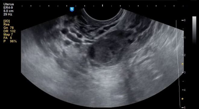 Снимок геморрагической кисты яичника на УЗИ
