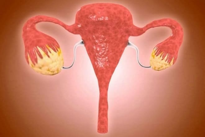 Как выглядит гипертрофия яичника