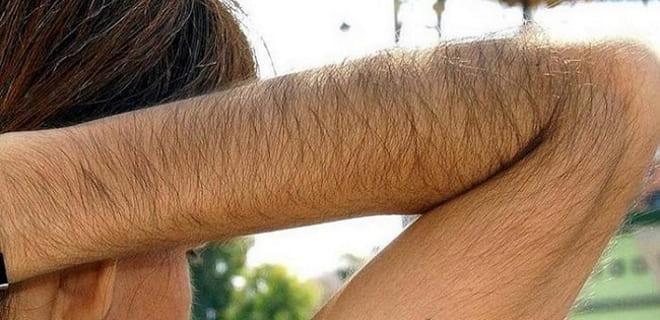 Оволосение по мужскому типу при дисбалансе гормонов