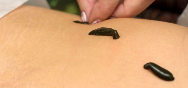 Лечение атрофии яичников гирудотерапией