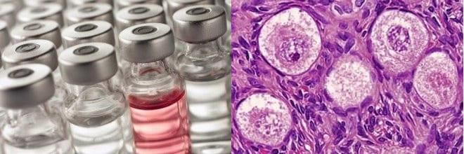 Химиотерапия и дисгерминома