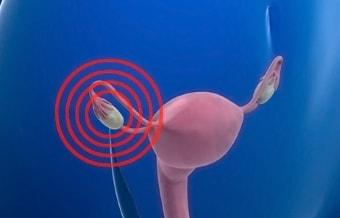 Проведение лучевой и химиотерапии яичника