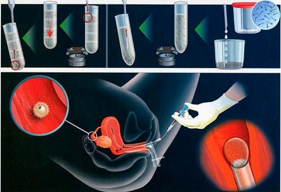 ЭКО при гипоплазии яичников