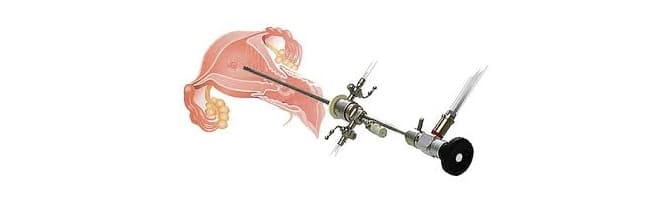 Гисторэктомия яичников и матки после 50 лет