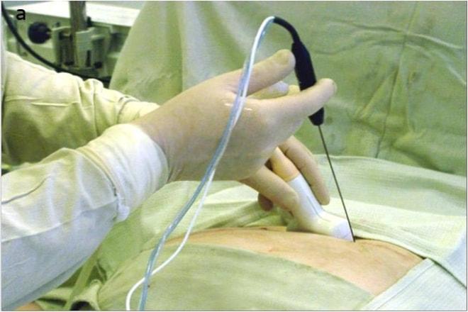 Пункция кисты яичника