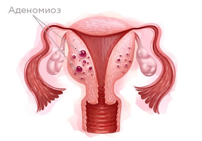 Аденомиоз