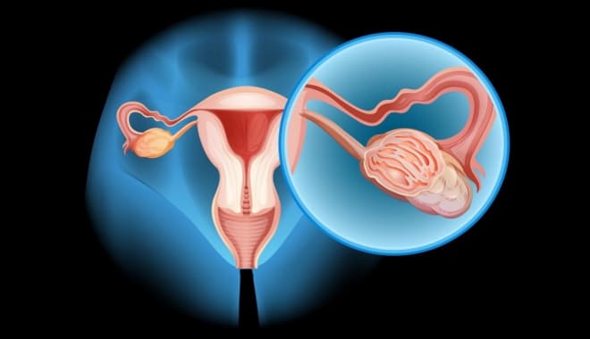 Карцинома яичника