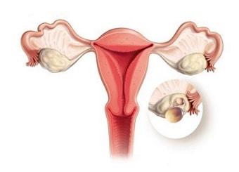 Вид кисты яичника