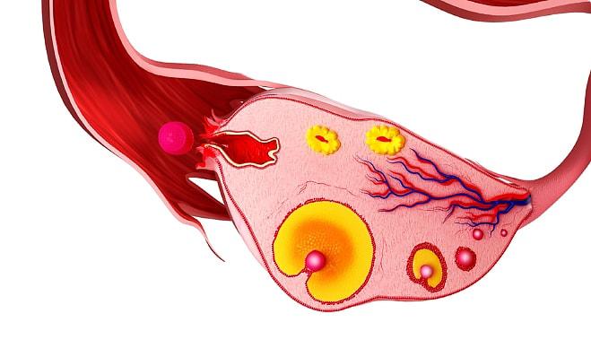 Киста жёлтого тела яичника