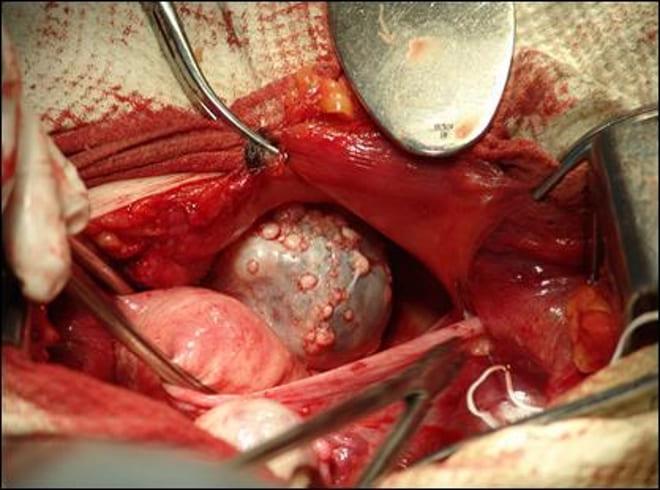 Кистома левого яичника