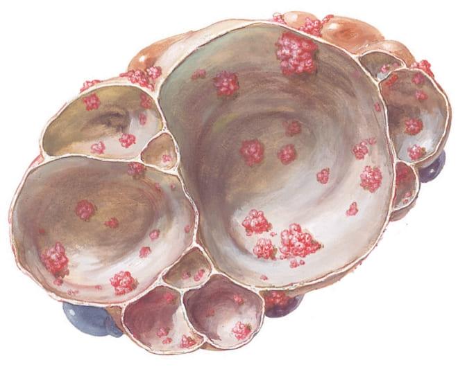 Папиллярная муцинозная цистаденома яичника на фото