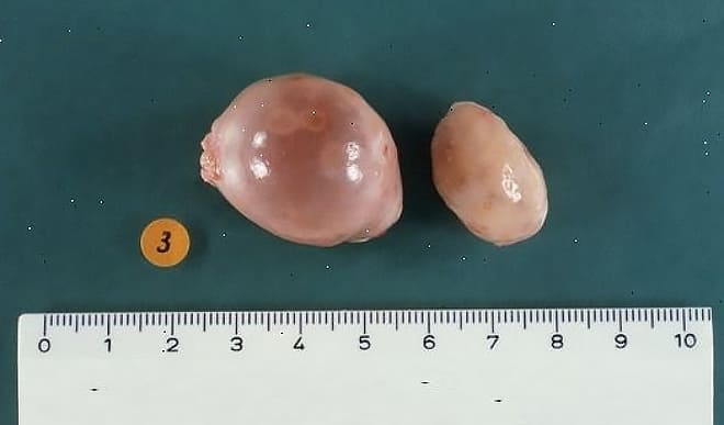 Удалённая паратубарная киста яичника