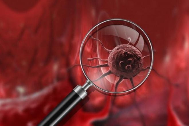 Проявление рака яичников и матки у женщины