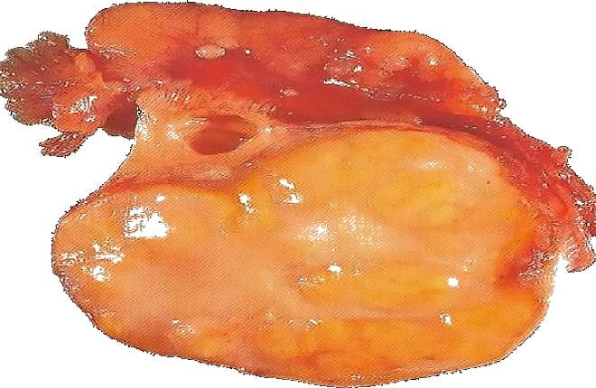 Текома яичников на фото