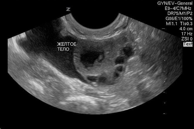 Жёлтое тело в яичнике женщины при УЗИ