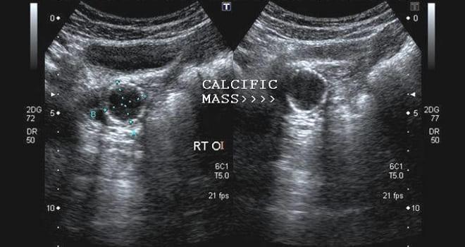 Как выглядят кальцинаты в яичниках на УЗИ