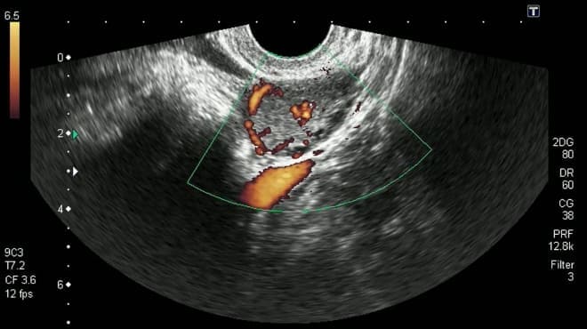 УЗИ кисты жёлтого тела яичника при беременности