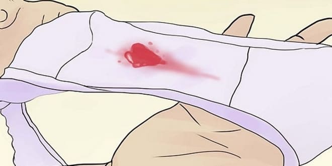 Обильно кровотечение при разрыве кисты жёлтого тела яичника