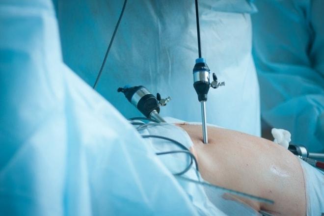 Удаление цистаденомы с помощью лапароскопии