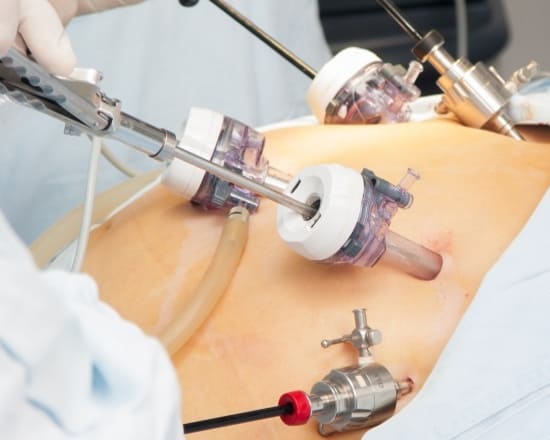 Как проводится лапароскопия муцинозной кисты яичника