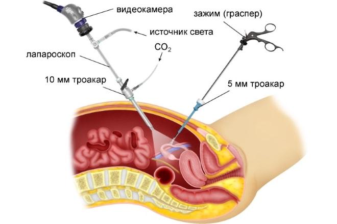 Методика проведения лапароскопии при поликистозе яичников