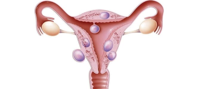 Проявление эндометриоза и миомы матки