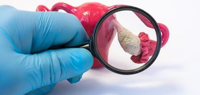 Киста яичника в увеличенном размере