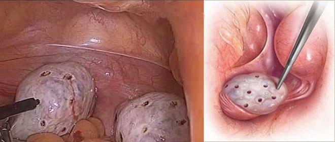 Надрезы на яичниках