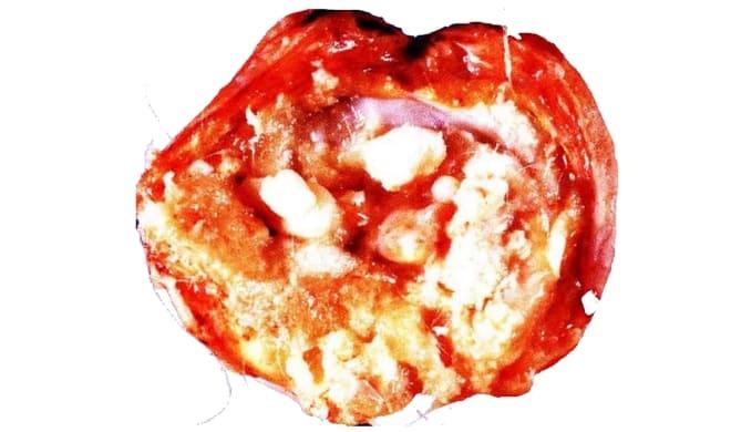 Незрелая тератома яичника