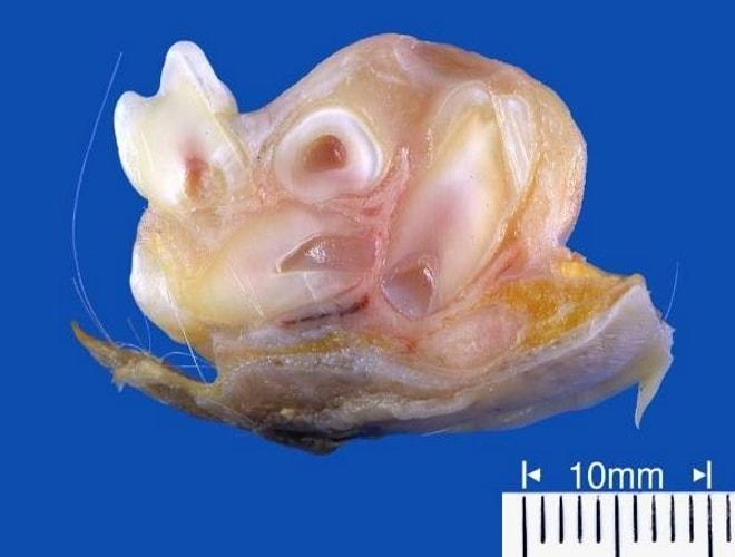 Экземпляр тератомы