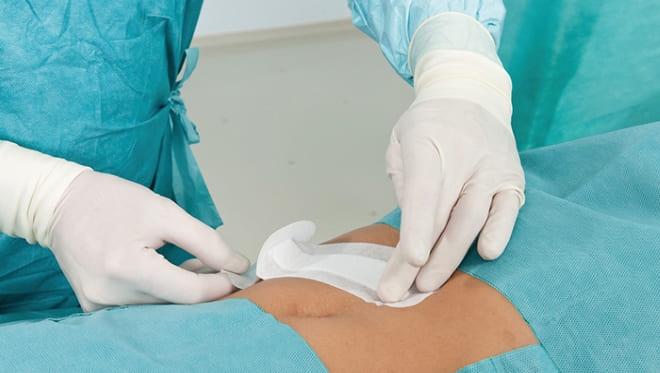 Шрамы после лапароскопии обрабатываются антисептиком