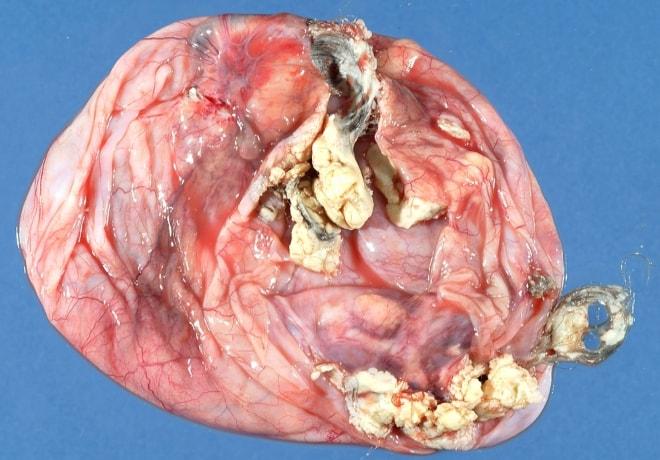 Фото опухолевидного дермоидного образования
