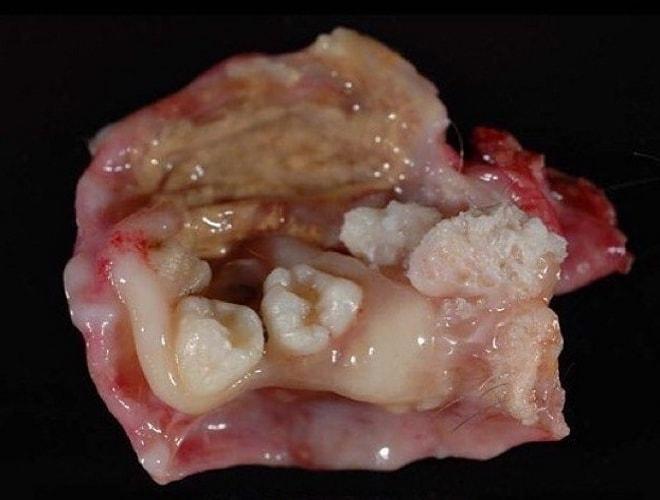 Удалённая тератома придатка женщины